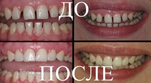 Способы эстетической реставрации зубов